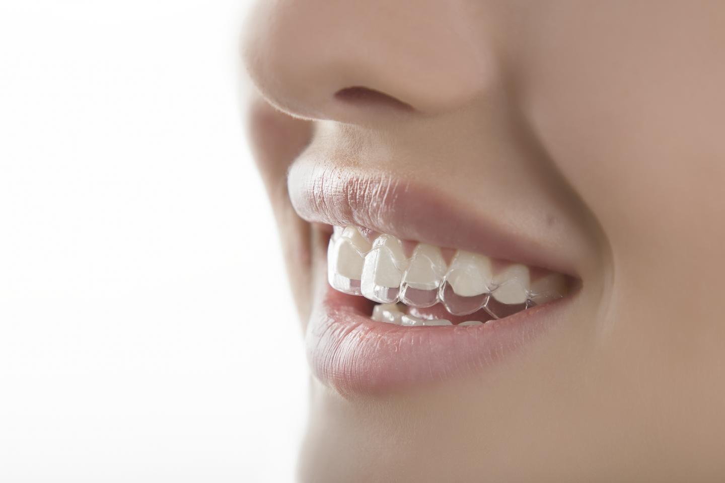 Advantages of treatment with OrthoAlight aligners. Psychological